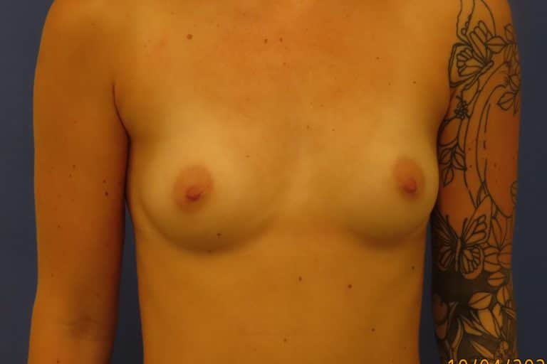 Before Image: Patient # 4179 - front