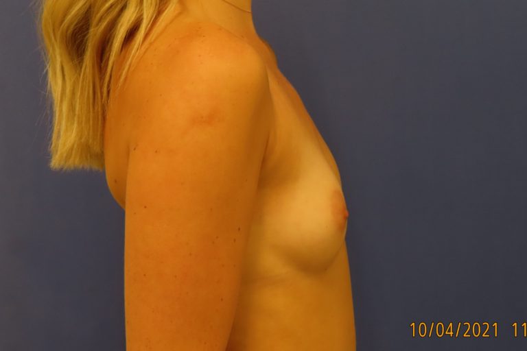 Before Image: Patient # 4179 - right-side