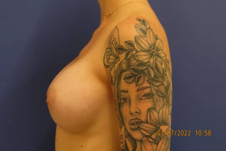 After Image: Patient # 4179 - left-side
