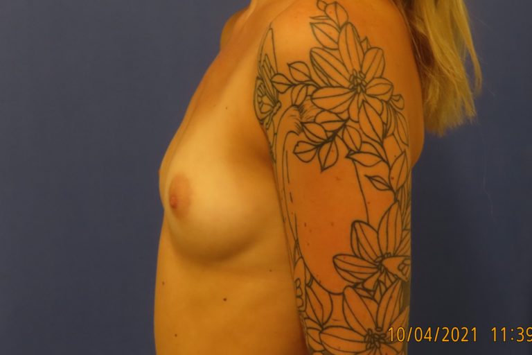 Before Image: Patient # 4179 - left-side