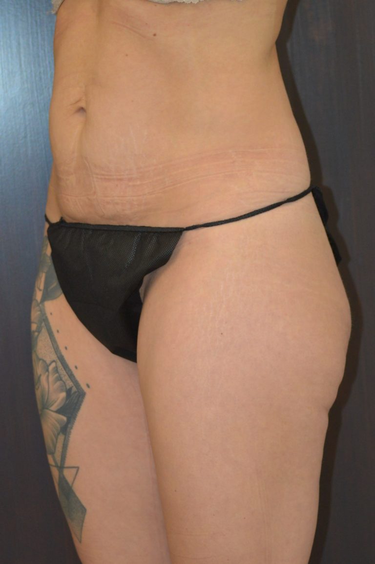 Before Image: Patient # 4276 - front