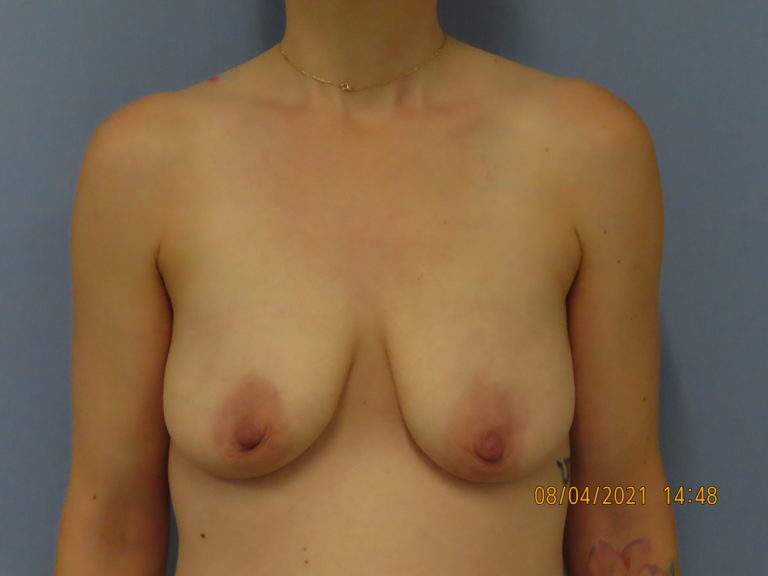 Before Image: Patient # 4256 - front