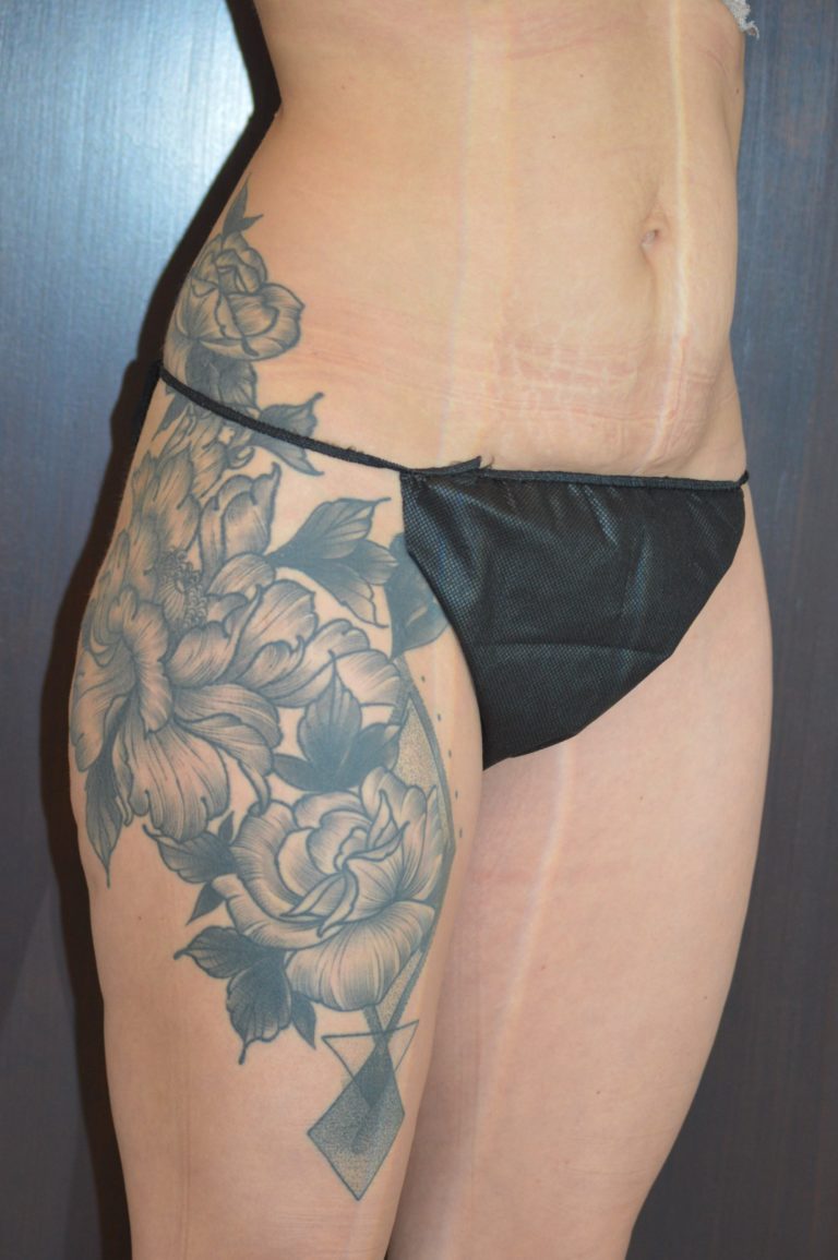 Before Image: Patient # 4276 - front