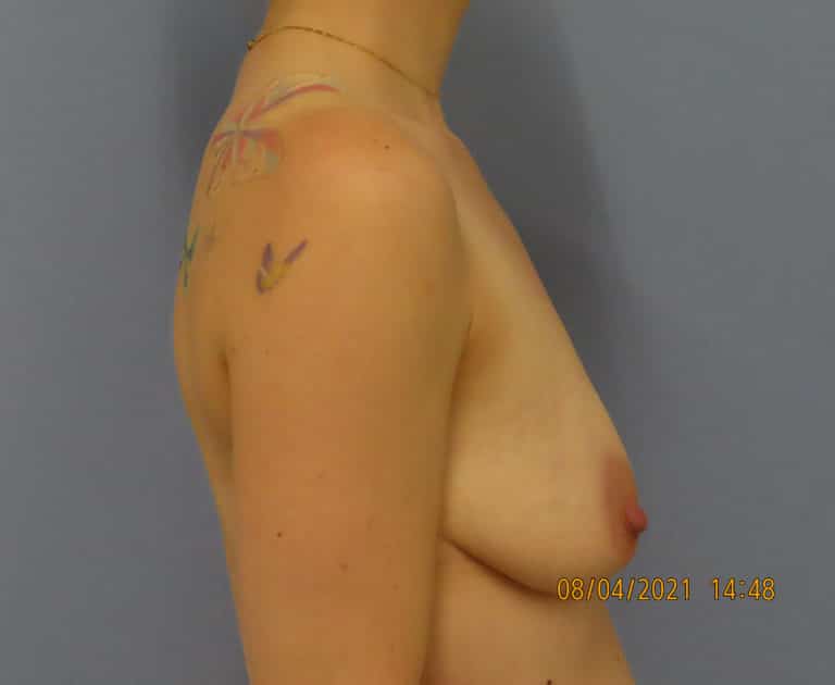 Before Image: Patient # 4256 - front