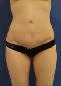 After Image: Patient #14251