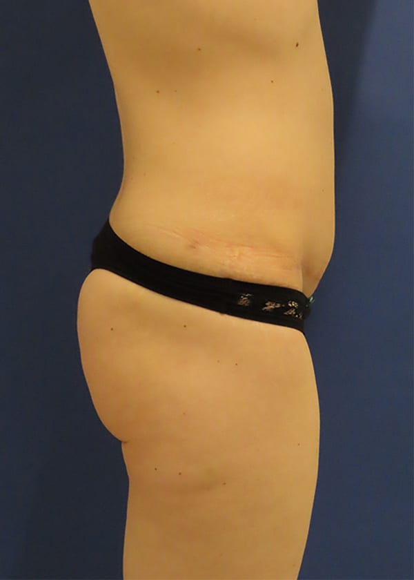 After Image: Patient #14241 - right-side