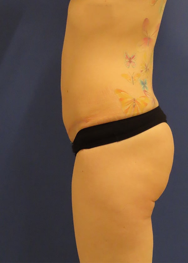 After Image: Patient #14241 - left-side