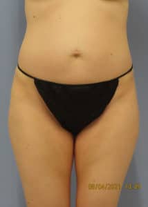 Before Image: Patient #14251