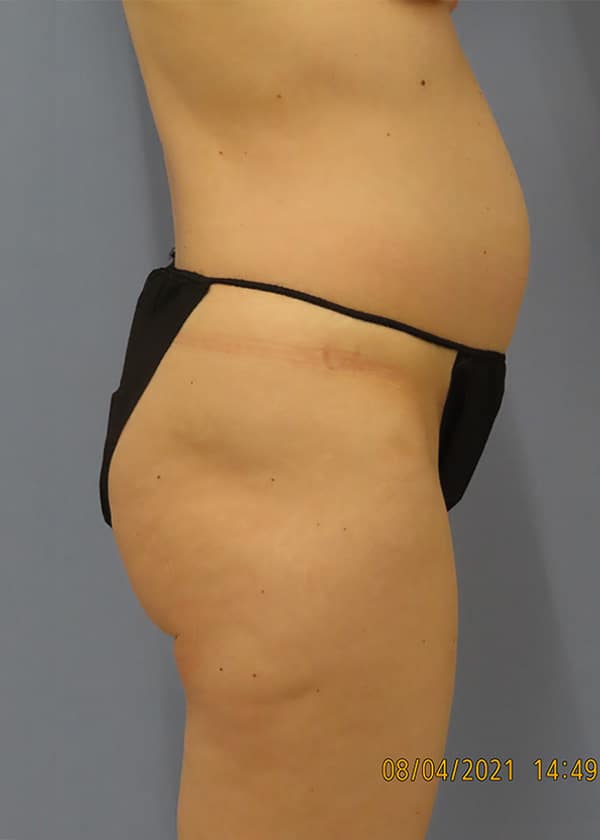 Before Image: Patient #14241 - right-side