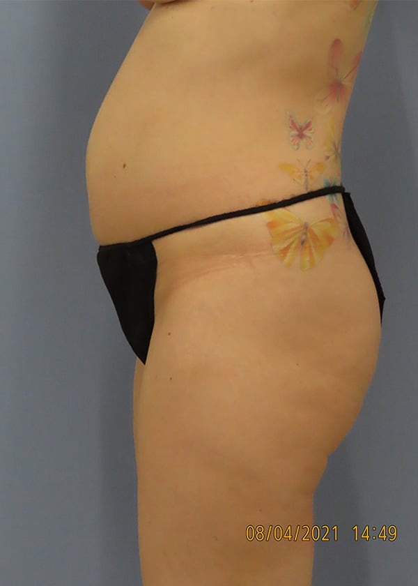Before Image: Patient #14241 - left-side