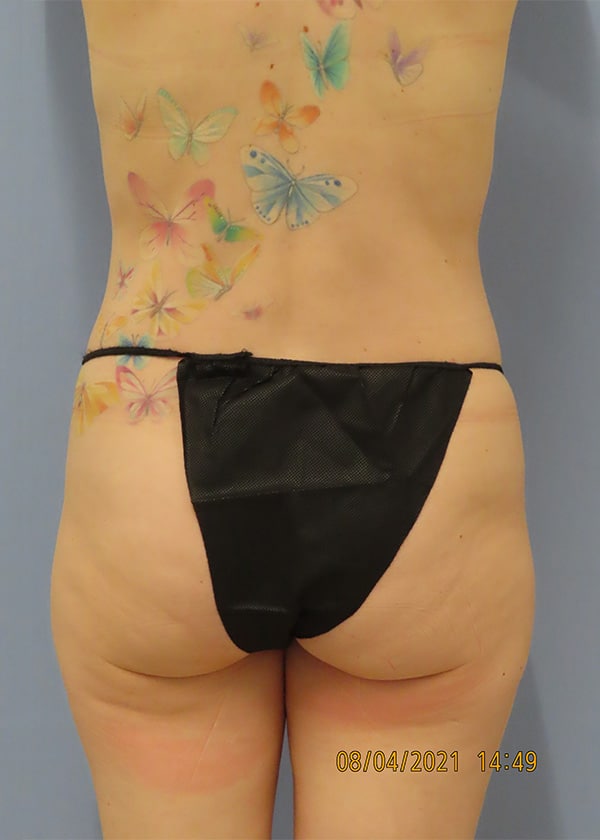 Before Image: Patient #14241 - back