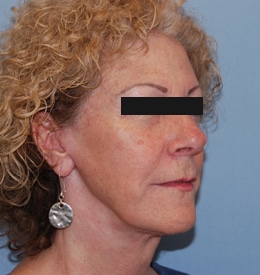 side profile of woman after neck lift procedure, jawline more defined after procedure