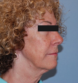 side profile of woman before neck lift procedure