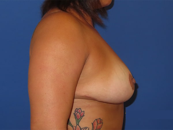 After Image: Patient # 4381 - right-side