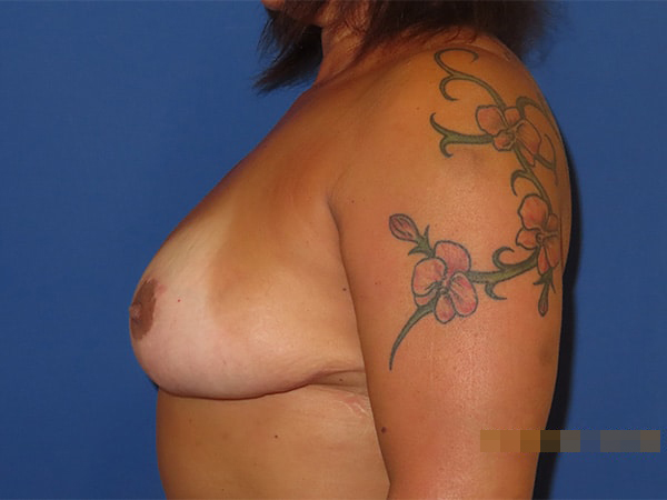 After Image: Patient # 4381 - front