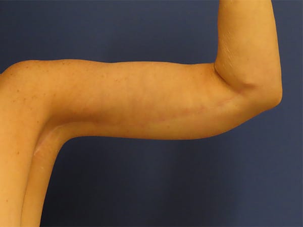 After Image: Patient # 4428 - front