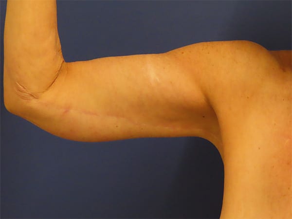 After Image: Patient # 4428 - front