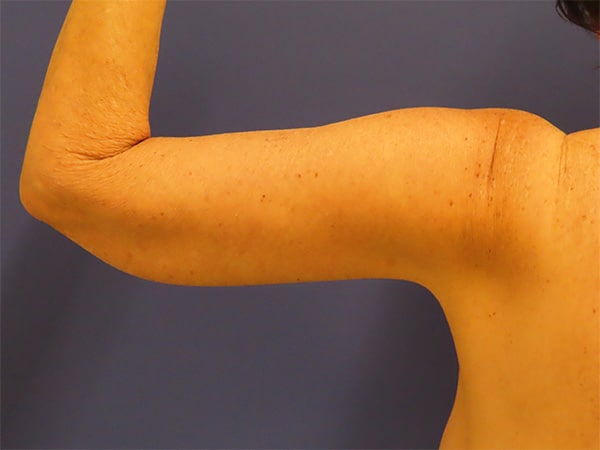 After Image: Patient # 4428 - back