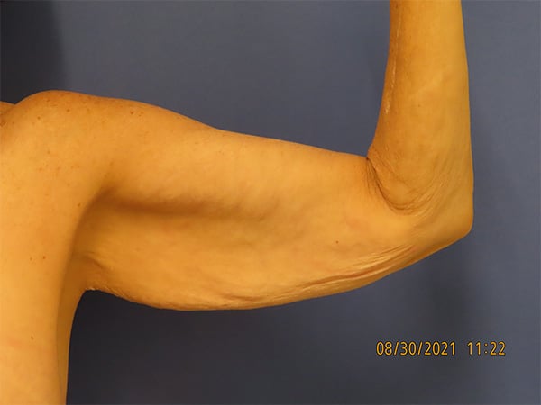 Before Image: Patient # 4428 - front