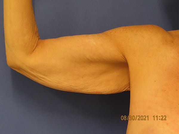 Before Image: Patient # 4428 - front