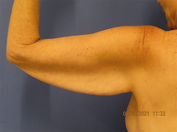 Before Image: Patient # 4428 - back