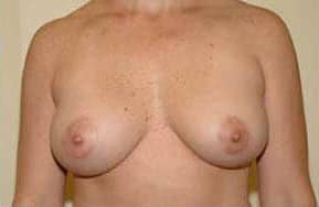After Image of Breast Lift La Jolla