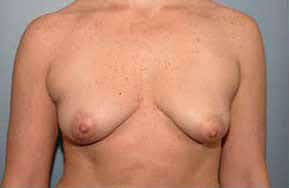Before Image of Breast Lift La Jolla