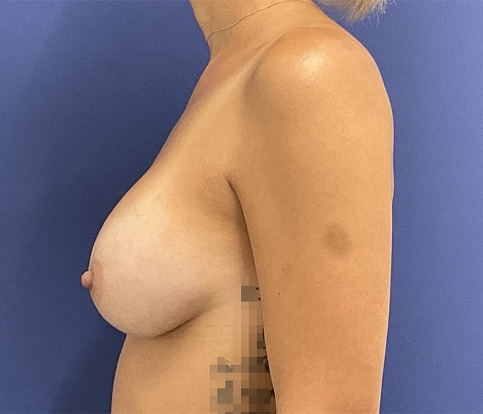 After Image: Patient # 4461 - left-side
