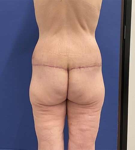 After Image: Patient # 4538 - back