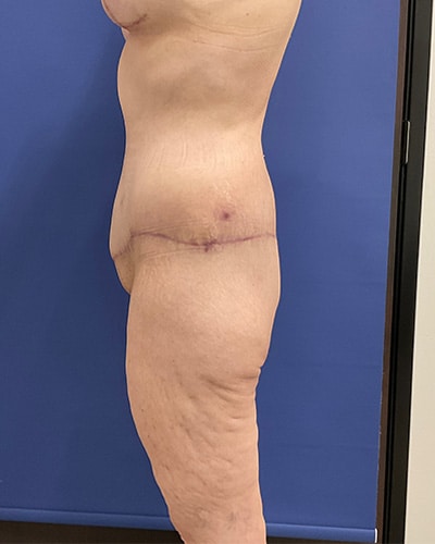 After Image: Patient # 4538 - left-side