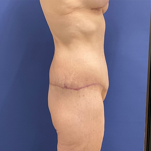 After Image: Patient # 4538 - right-side
