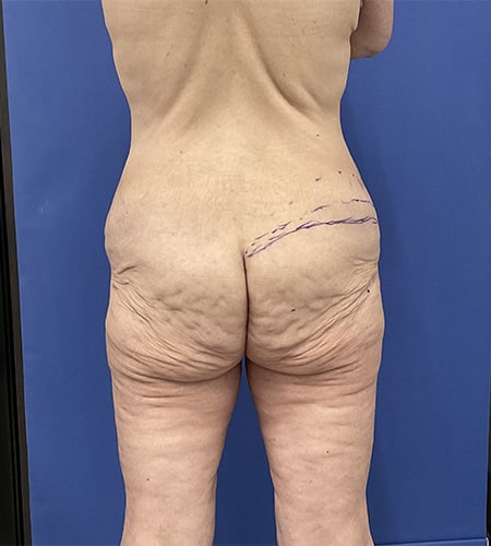 Before Image: Patient # 4538 - back