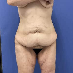Before Image: Patient # 4538
