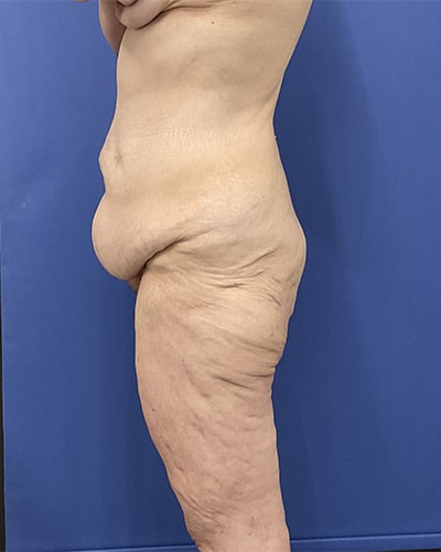 Before Image: Patient # 4538 - left-side