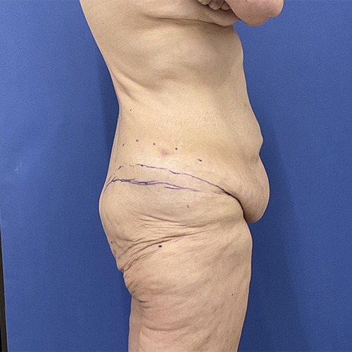Before Image: Patient # 4538 - right-side