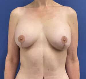 After Image: Patient # 4553