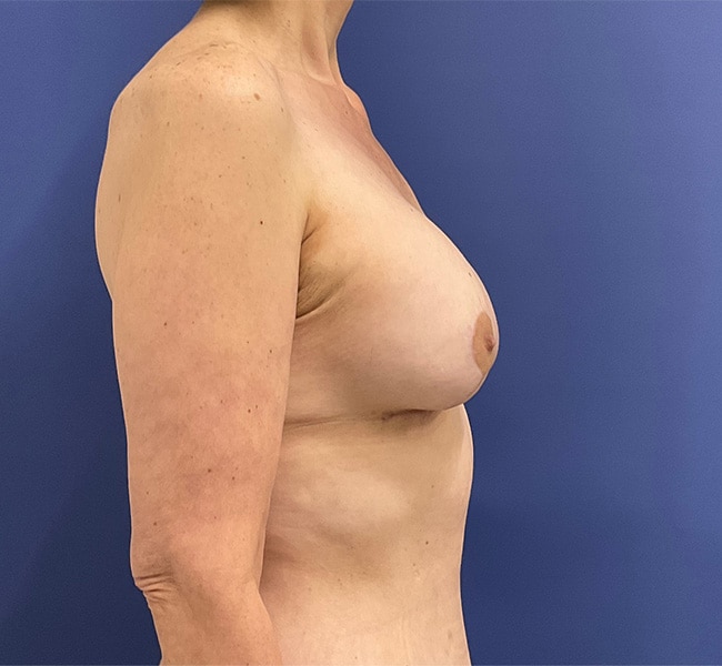 After Image: Patient # 4553 - right-side