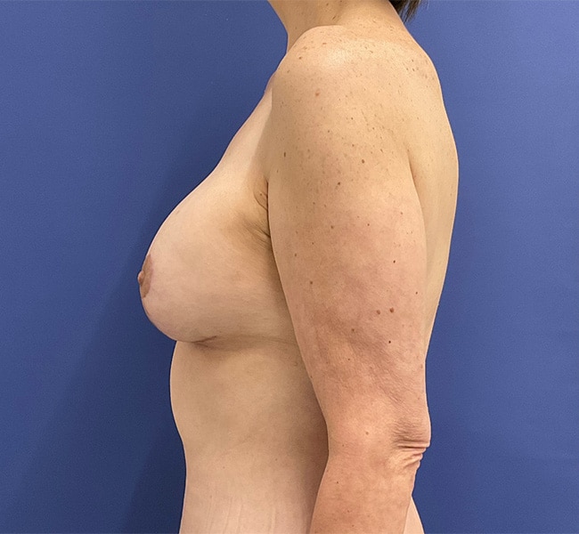 After Image: Patient # 4553 - left-side