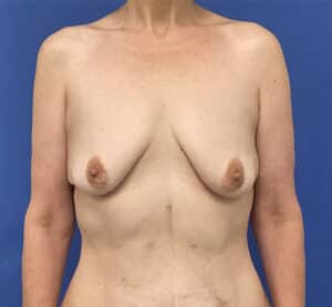 Before Image: Patient # 4553