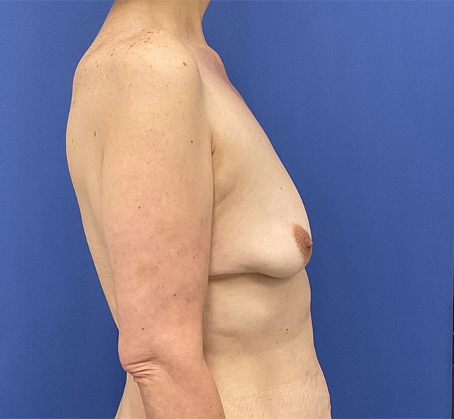 Before Image: Patient # 4553 - right-side