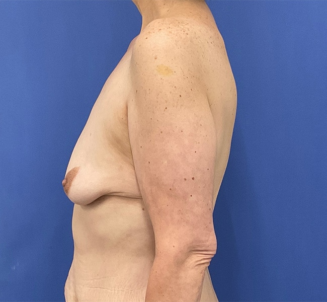 Before Image: Patient # 4553 - left-side