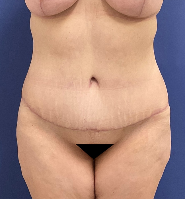 After Image: Patient # 4597 - front