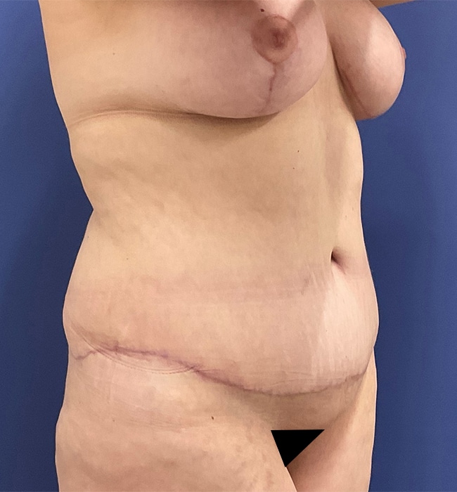 After Image: Patient # 4597 - right-front-oblique