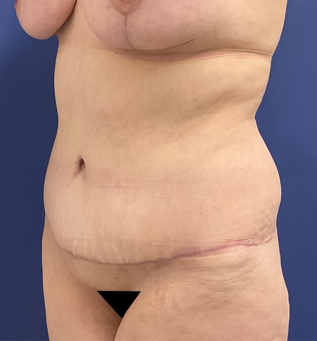 After Image: Patient # 4597 - left-front-oblique
