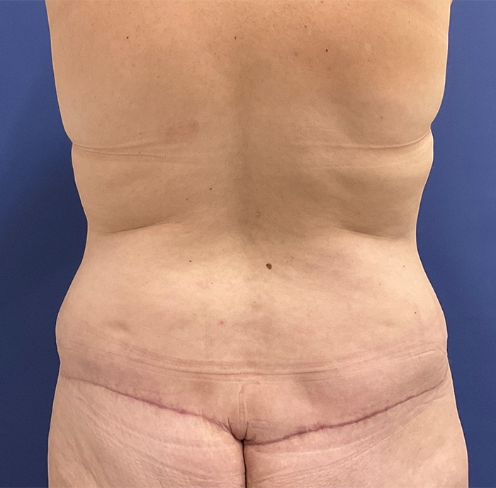 After Image: Patient # 4597 - back