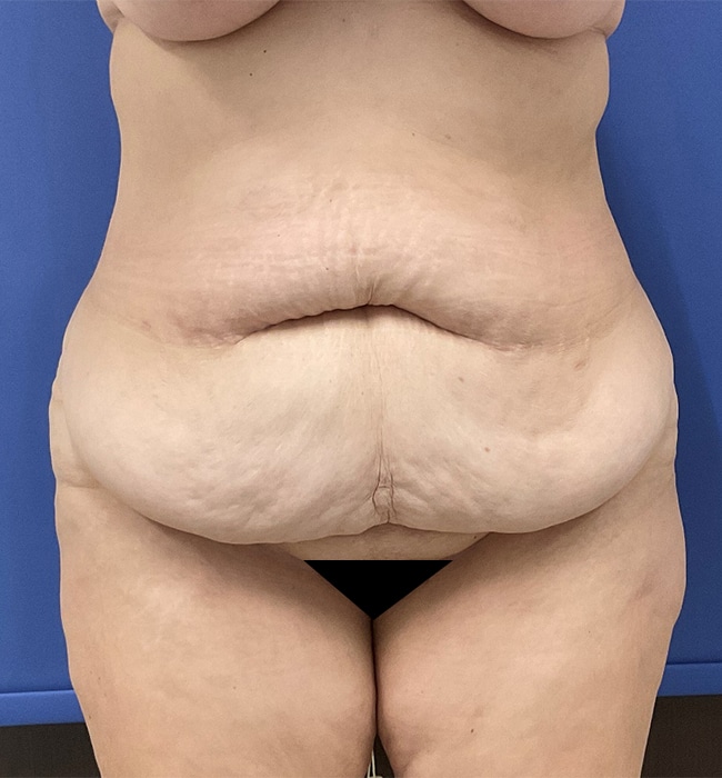 Before Image: Patient # 4597 - front