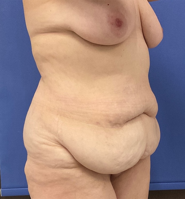 Before Image: Patient # 4597 - right-front-oblique