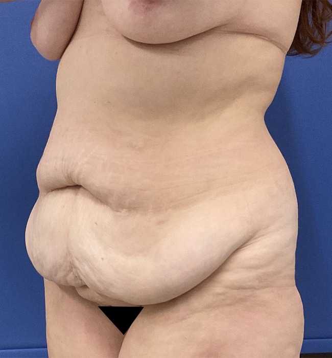 Before Image: Patient # 4597 - left-front-oblique