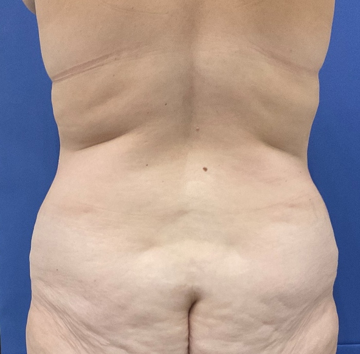 Before Image: Patient # 4597 - back