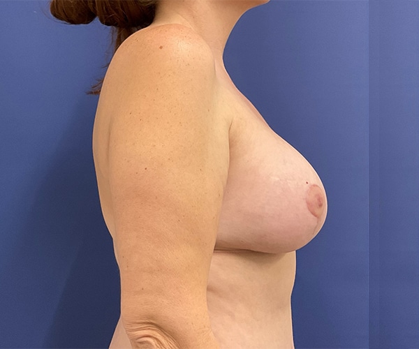 After Image: Patient # 4611 - right-side